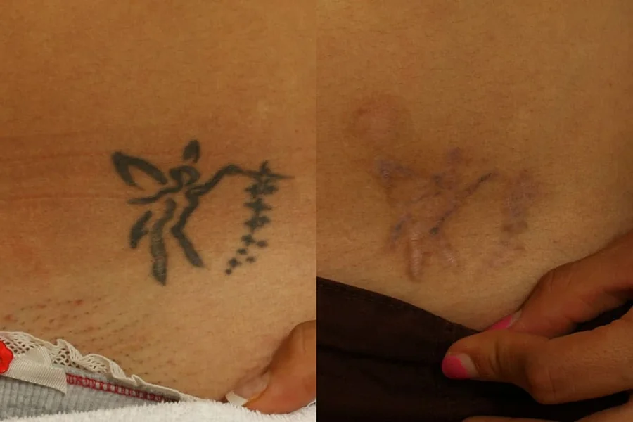 Tattoo Removal